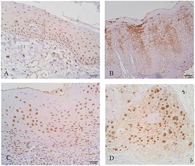 Expression of Interleukin-1ß and Interleukin-8 in Oral Potentially Malignant Disorders and Carcinomas